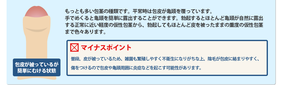 包皮が被っているが簡単にむける状態