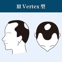 ⅢVertex型
