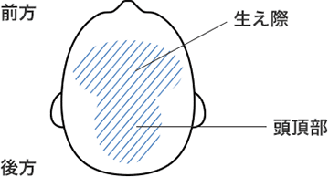 AGA発症場所